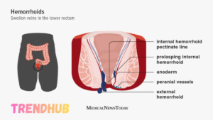 perianal hematoma